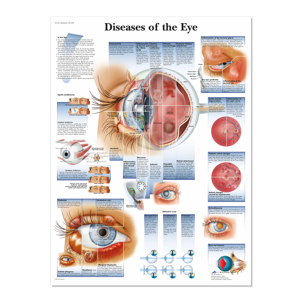 Diseases of the Eye Poster
