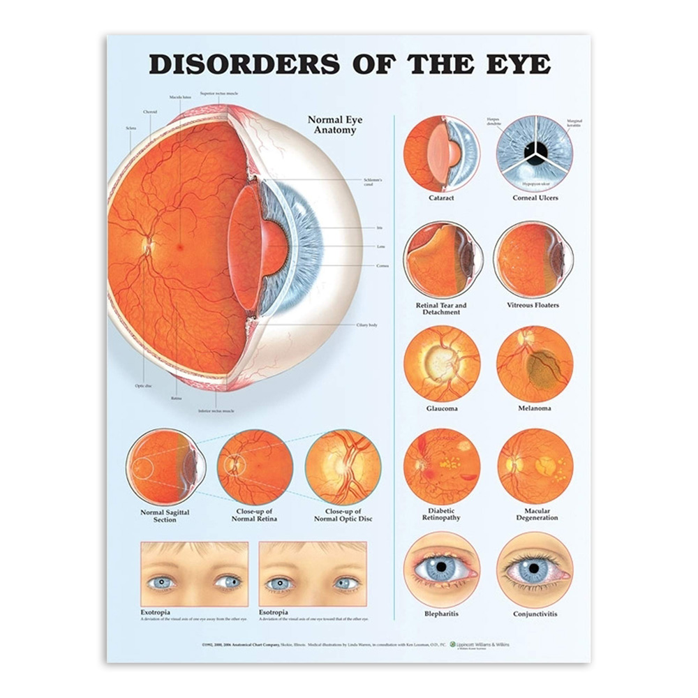 Laminated Chart - Disorders of the Eye