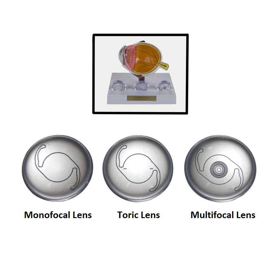 Premium IOL Options Lens Set