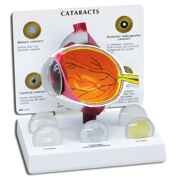 Eye Model with Cataracts
