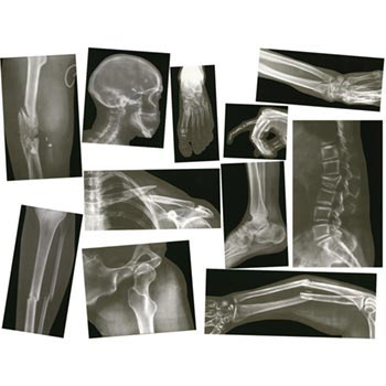 Broken Bones X-Rays