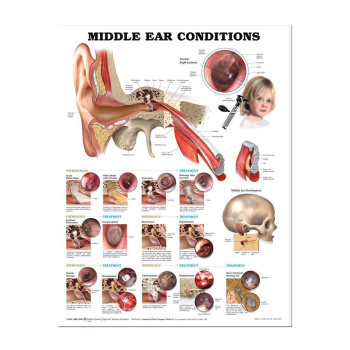 Middle Ear Conditions- Laminated Chart Poster 20 in. x 26 in.